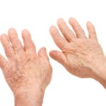 Do You Have Gout? Gout