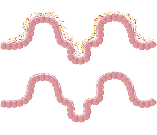 Leaky Gut Syndrome Leaky Gut Syndrome