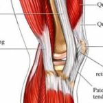 iliotibial band syndrome