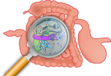 Ulcerative Colitis