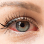 Dry Eye Symptoms