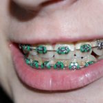 5 Ways To Take Care Of Adult Braces Adult Braces