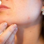 Acne Prevention Tips & Tricks Acne Prevention