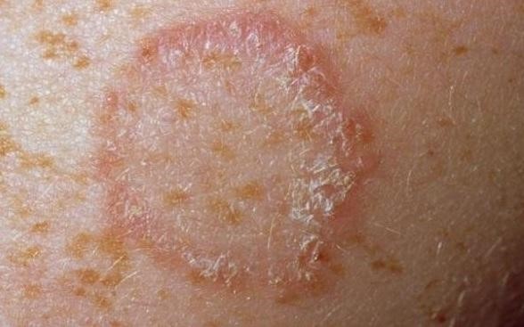 ringworm natural remedy