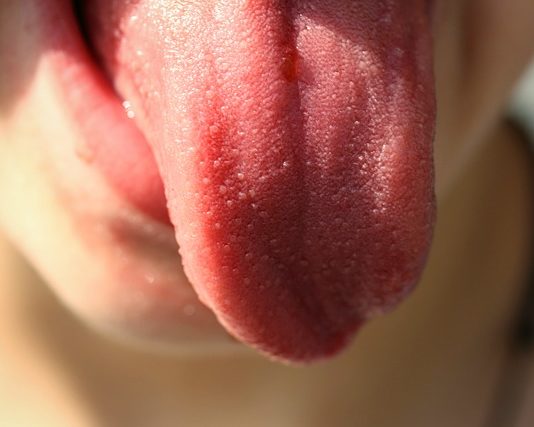 burnt tongue